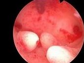 三代试管助孕一次费用多少？这个价格做成功真的值